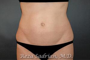 Tummy Tuck Before & After Image