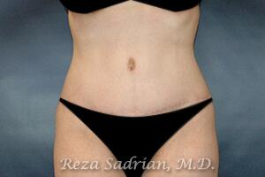 Tummy Tuck Before & After Image