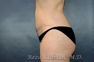 Tummy Tuck Before & After Image