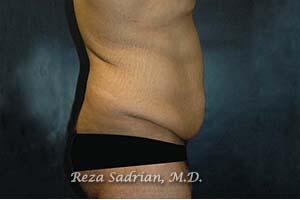 Tummy Tuck Before & After Image