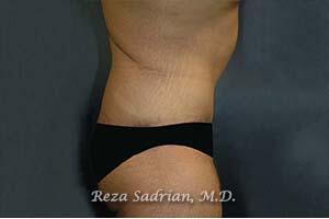 Tummy Tuck Before & After Image