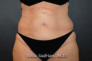 Tummy Tuck Before & After Image