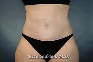 Tummy Tuck Before & After Image