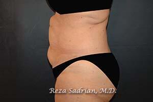 Tummy Tuck Before & After Image