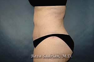 Tummy Tuck Before & After Image