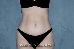 Tummy Tuck Before & After Image