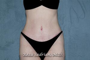 Tummy Tuck Before & After Image