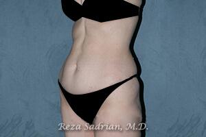 Tummy Tuck Before & After Image