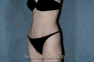 Tummy Tuck Before & After Image