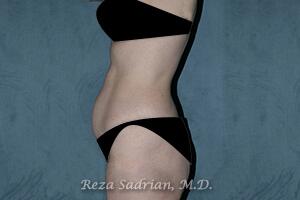 Tummy Tuck Before & After Image