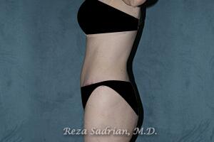 Tummy Tuck Before & After Image