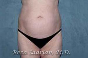 Tummy Tuck Before & After Image