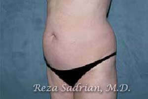 Tummy Tuck Before & After Image