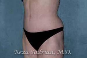 Tummy Tuck Before & After Image