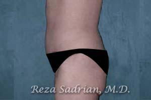 Tummy Tuck Before & After Image