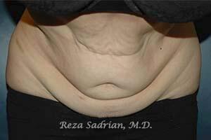 Tummy Tuck Before & After Image