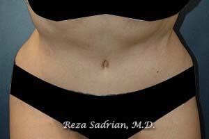 Tummy Tuck Before & After Image