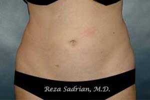 Tummy Tuck Before & After Image