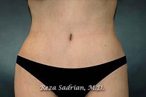 Tummy Tuck Before & After Image