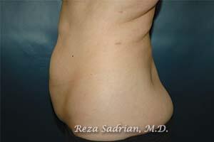 Tummy Tuck Before & After Image