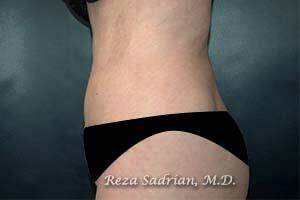 Tummy Tuck Before & After Image