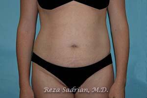 Tummy Tuck Before & After Image