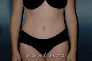 Tummy Tuck Before & After Image