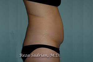 Tummy Tuck Before & After Image