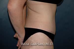 Tummy Tuck Before & After Image