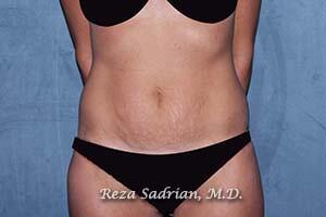 Tummy Tuck Before & After Image