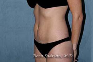 Tummy Tuck Before & After Image