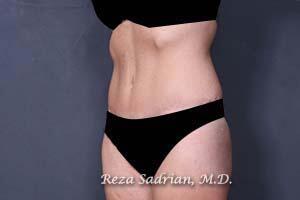 Tummy Tuck Before & After Image