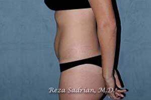 Tummy Tuck Before & After Image