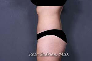 Tummy Tuck Before & After Image