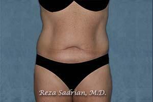 Tummy Tuck Before & After Image