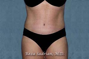 Tummy Tuck Before & After Image