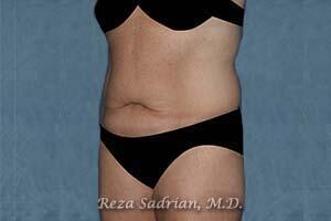 Tummy Tuck Before & After Image