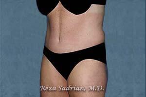 Tummy Tuck Before & After Image