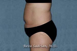 Tummy Tuck Before & After Image