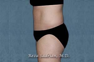 Tummy Tuck Before & After Image