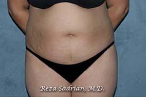 Tummy Tuck Before & After Image