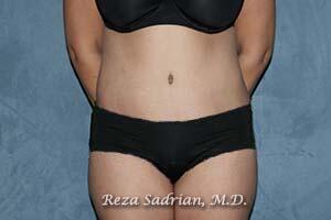 Tummy Tuck Before & After Image