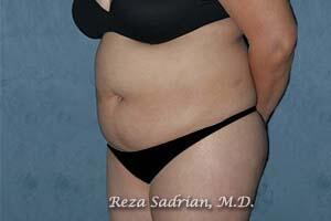 Tummy Tuck Before & After Image