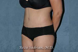 Tummy Tuck Before & After Image