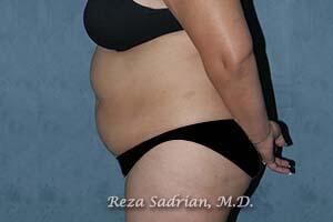 Tummy Tuck Before & After Image