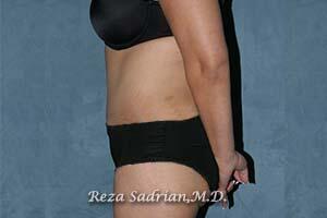 Tummy Tuck Before & After Image