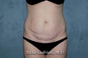 Tummy Tuck Before & After Image