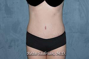 Tummy Tuck Before & After Image