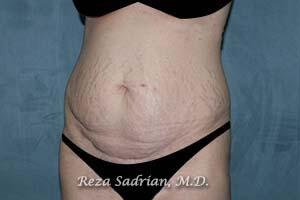 Tummy Tuck Before & After Image