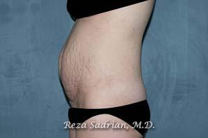 Tummy Tuck Before & After Image